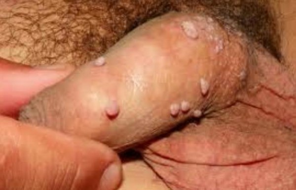 How to get rid of genital warts, treatment and symptoms